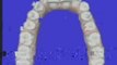 Alpharetta Invisalign Invisaline Braces Align Teeth, Fix Sm