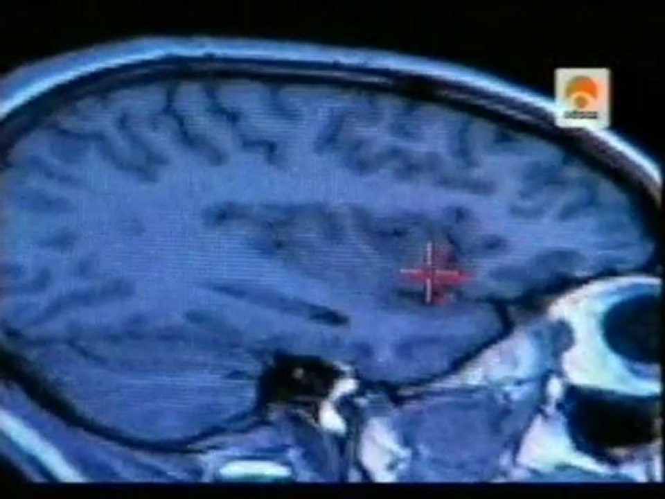 TDAH: Estudio de gemelos (cortex prefrontal)