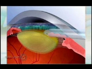 Gene’s Cataract Surgery Experience – Eye Institute Utah