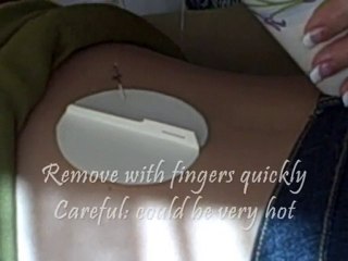 San Deigo Acupuncture Warming Needle Moxa Demonstration