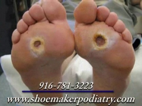 Diabetic Foot Care - Podiatrist in Roseville, CA