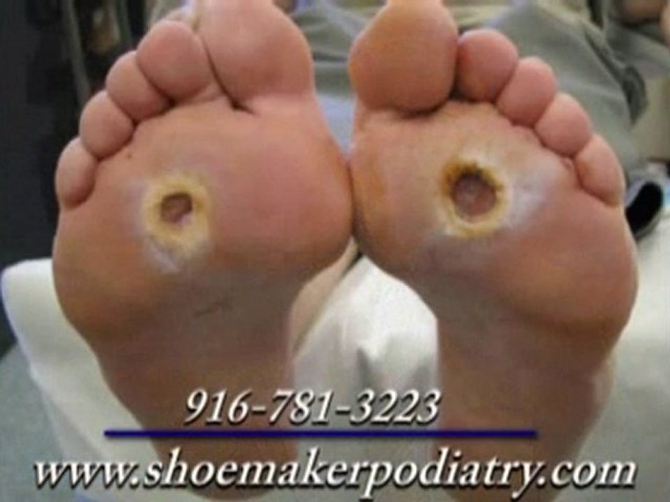 Diabetic Foot Care - Podiatrist in Roseville, CA