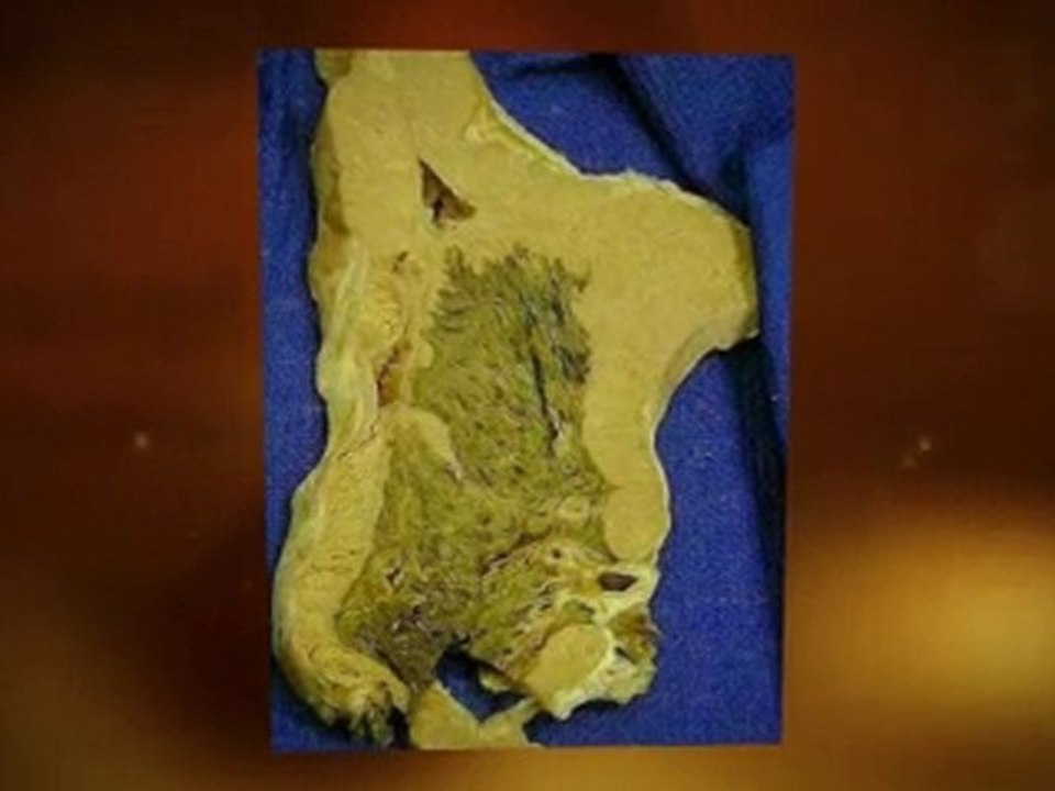 Asbestos Mold Problem Plantation FL