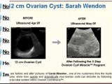 Ovarian Cyst Miracle™ - Cure Ovarian Cysts and PCOS