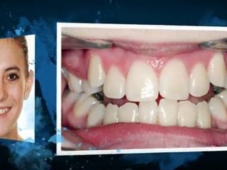 Westminster CO Orthodontist great new smiles