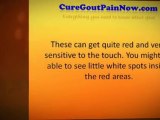 Joint Pain Might Be Gout