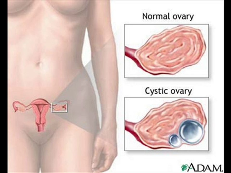 Ovarian Pain