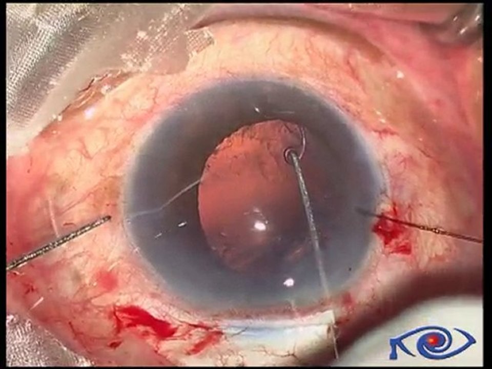 SICS- intraoperative zonular dialysis     Dr.NSD Raju,India