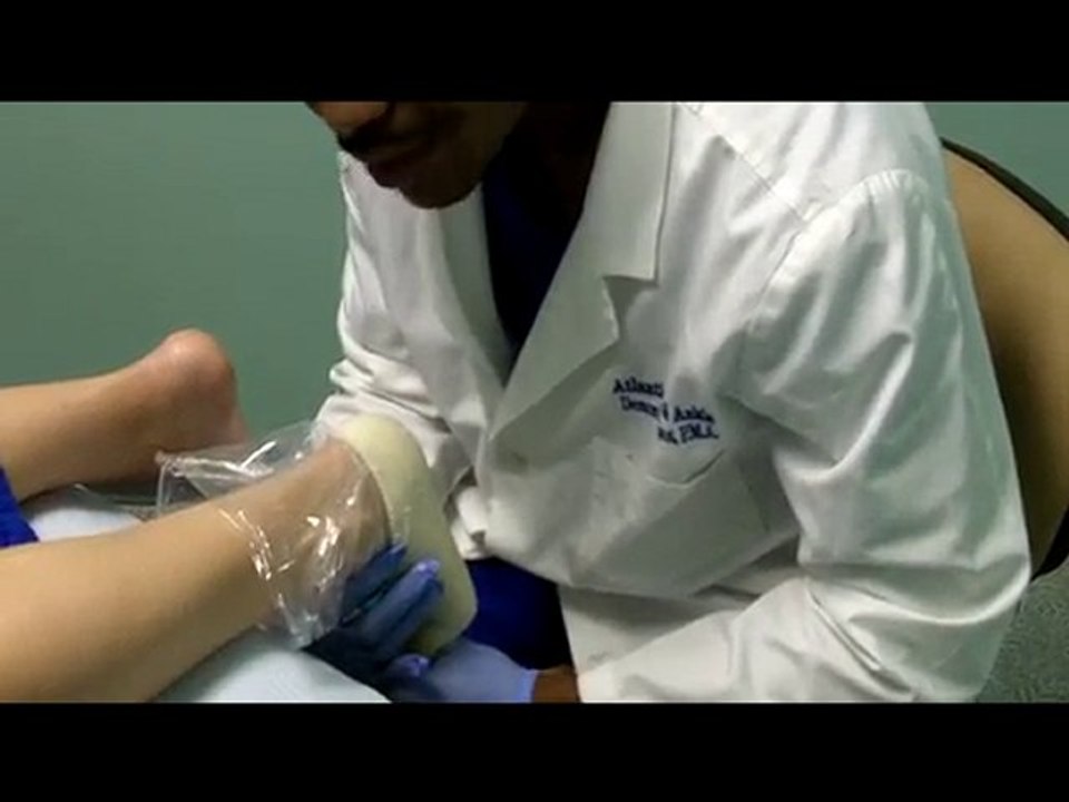 Certified Pedorthist Demon Thompson's Orthotic Casting