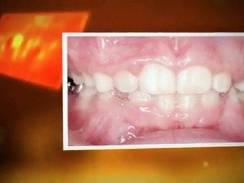 Orthodontist Fort Collins - Ebert Orthodontics