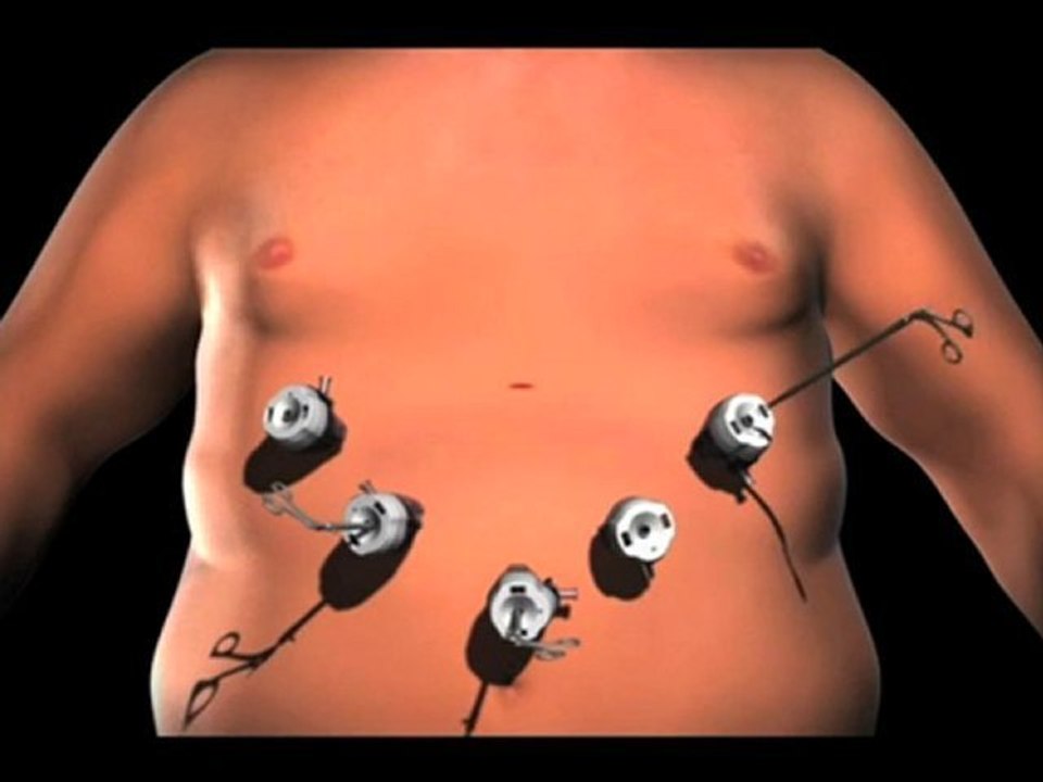 Lap band Surgery Austin