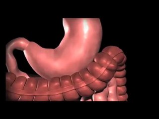 Lap band Surgery Austin