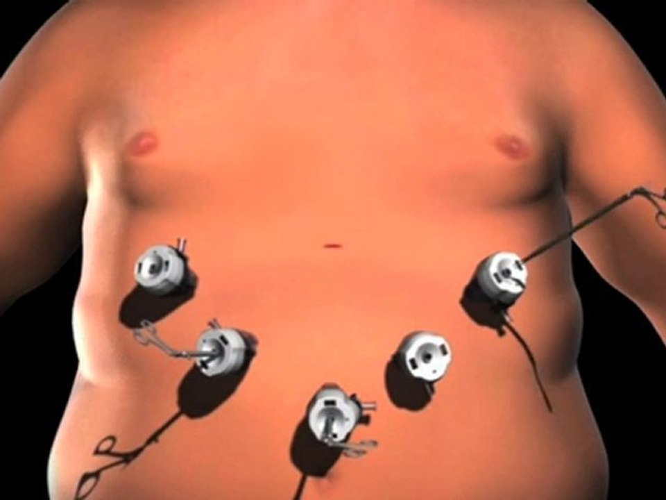 Lap band Surgery Austin