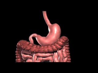 Lap band Surgery Austin