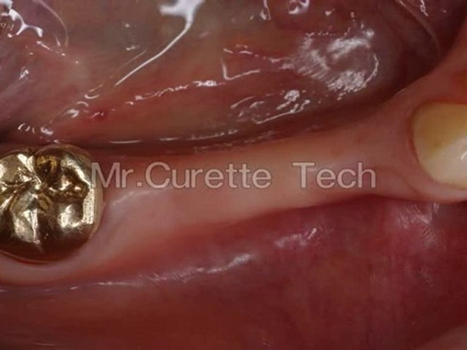 Mr.Curette Co.'s Bone Crester