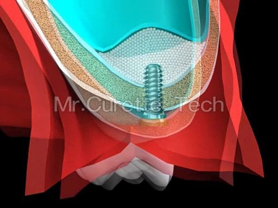 Mr.Curette Co.'s Sinus Master