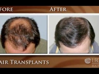 Hair Restoration in Massachusetts, New Hampshire