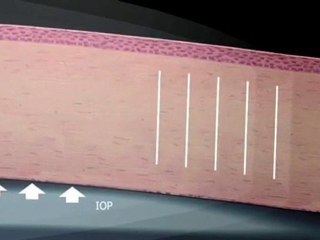 Présentation procédé laser intraCOR - Centre Laser New Visio