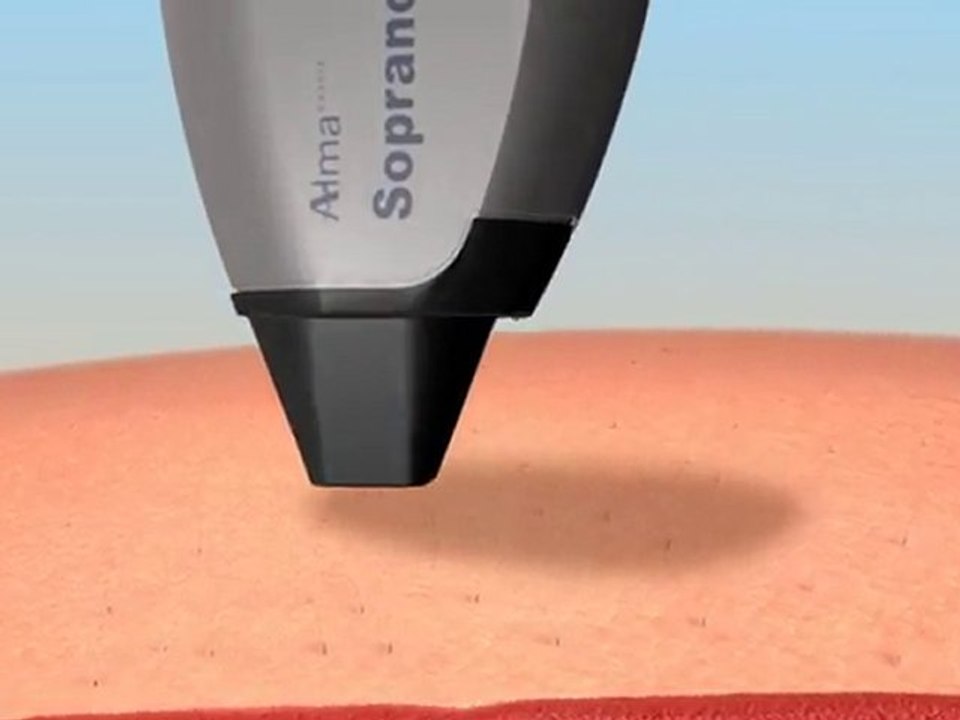 Soprano XL Ultra SHR