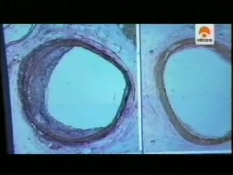 Estres: Enfermedad cardiovascular y obesidad