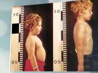 Cortisone Eczema Creams