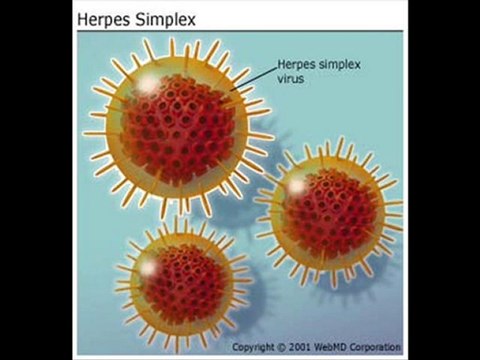 Herpes labial, herpes genital, tratamiento herpes,