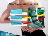 Spinal Decompression helps herniated discs