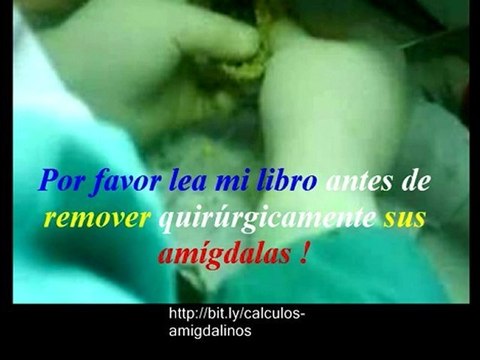 Tratamiento Para Infeccion de Garganta -Calculos Amigdalinos