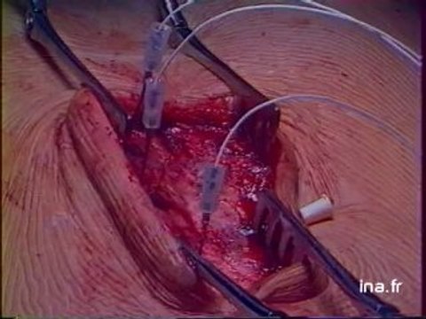 JA2 20H : EMISSION DU 12 MARS 1981