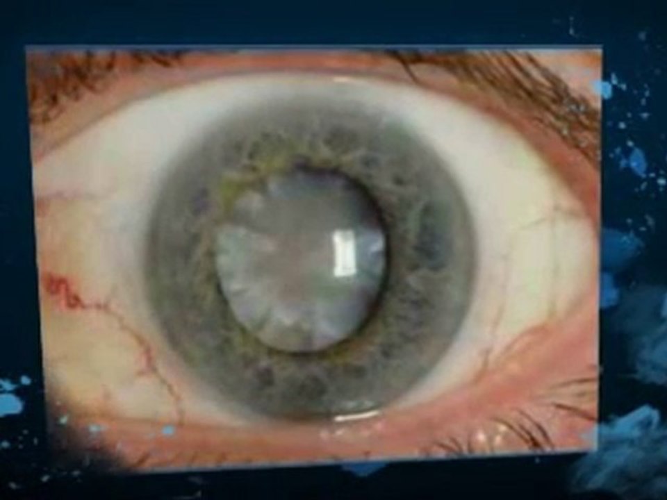 Can Steroids Heal Eczema Rashes?