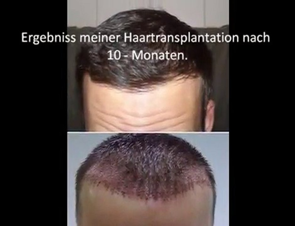 Haartransplantation, Haar, Istanbul, Türkei, www.melplast.de