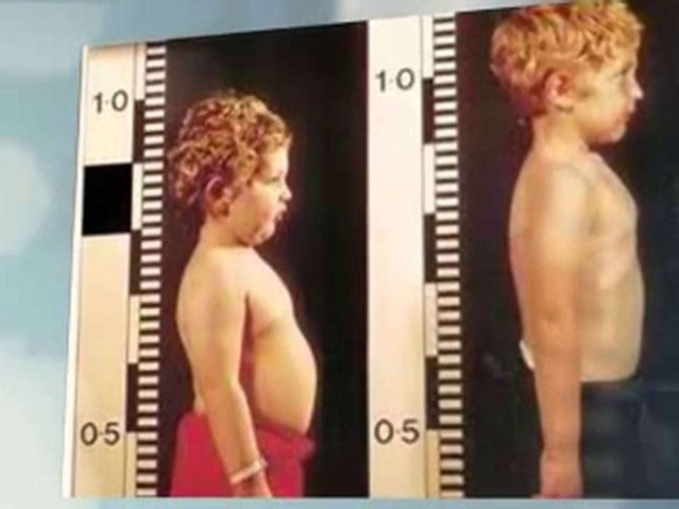 Cortisone Eczema Creams