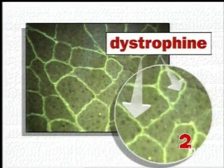 Myopathie