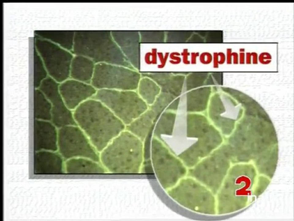 Myopathie
