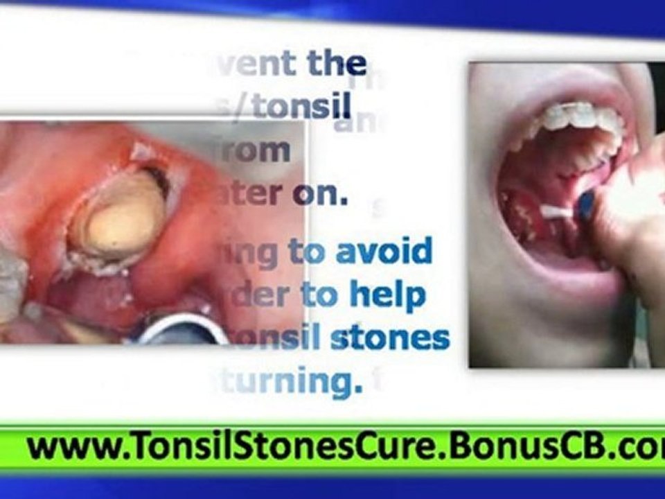 Tonsil Stones Treatment - Tonsil stones and Halitosis