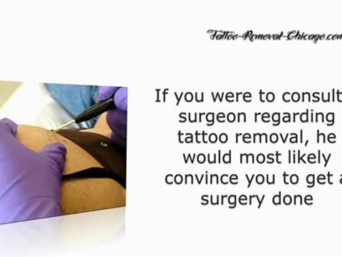 Tattoo Removal Chicago – Get Rid of Your Unwanted Tattoo