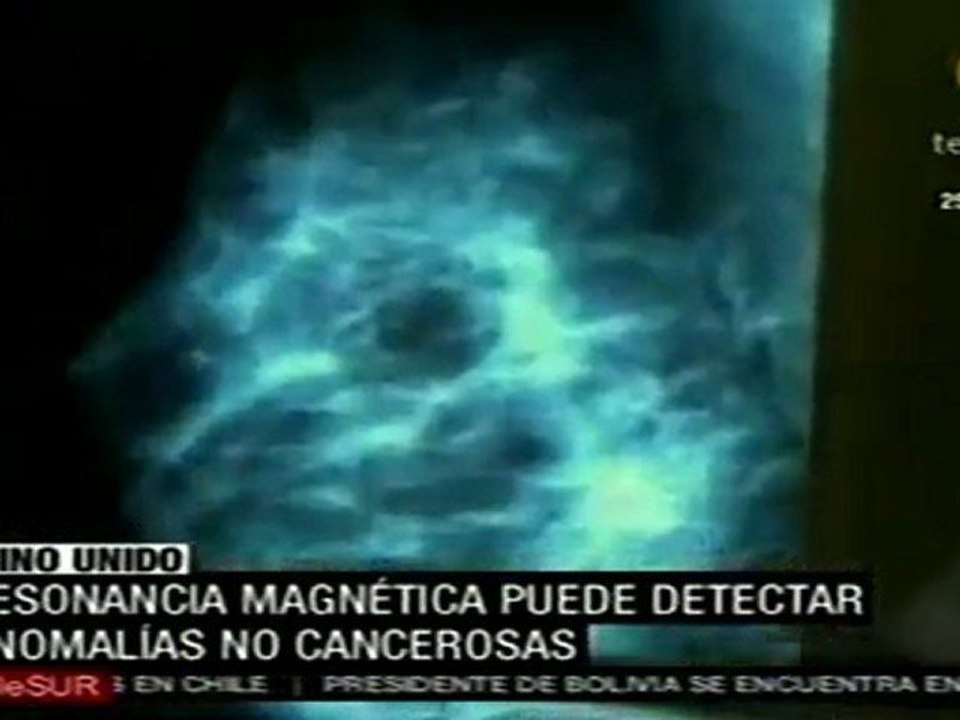 Nuevos criterios en la aplicación de sistemas de detección de cáncer de mama