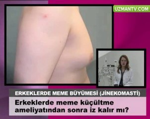 Descargar video: Erkeklerde meme kucultme  ameliyatindan sonra iz kalir mi