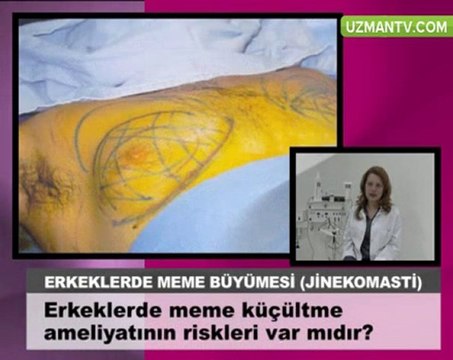 Erkeklerde meme kucultme ameliyatinin riskleri var midir