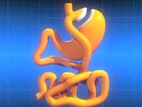 Obesidad, cirugia bariatrica, bypass gastrico, Colombia