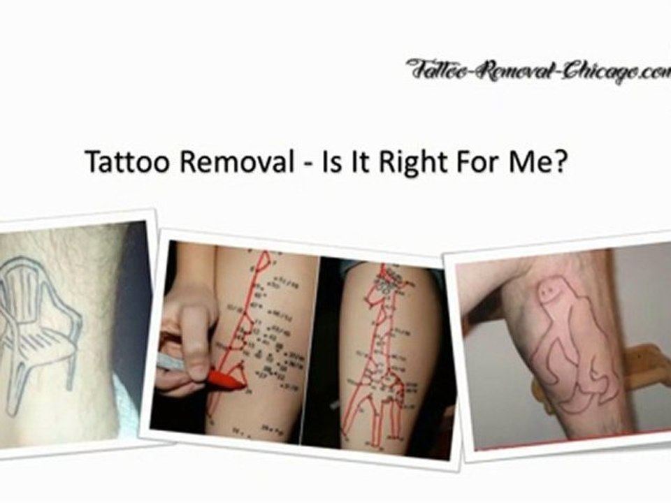 Chicago Tattoo Removal
