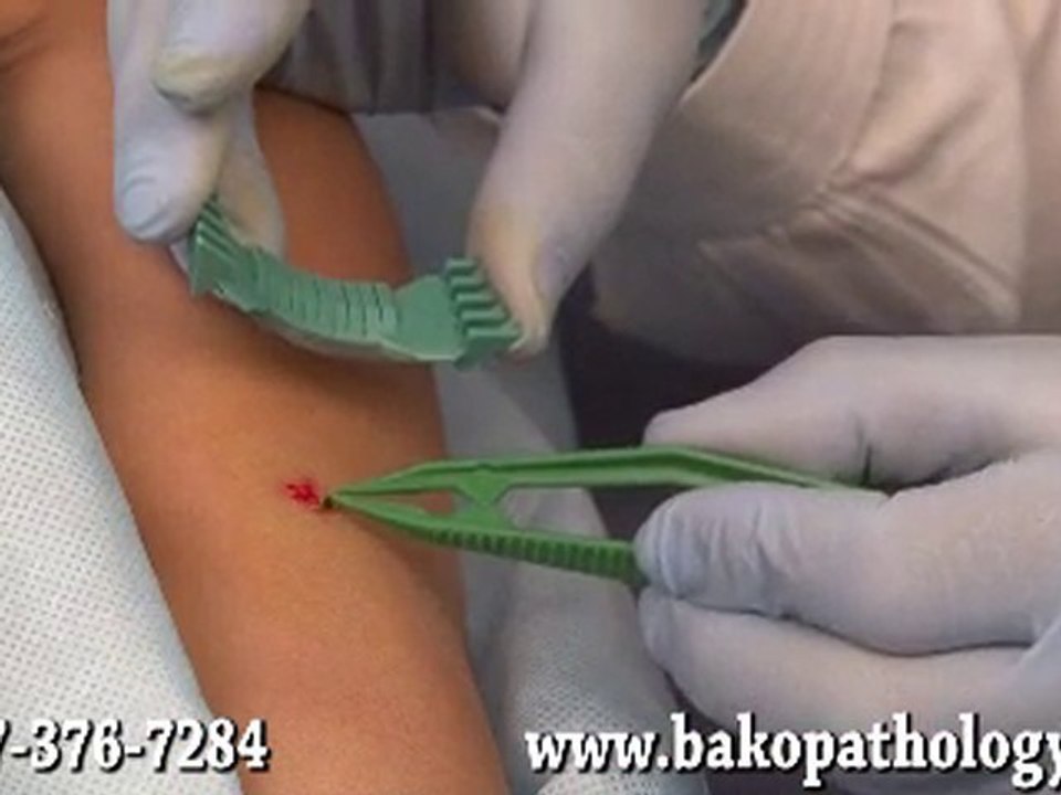 Bako Shave Biopsy - Bako Podiatric Pathology Services