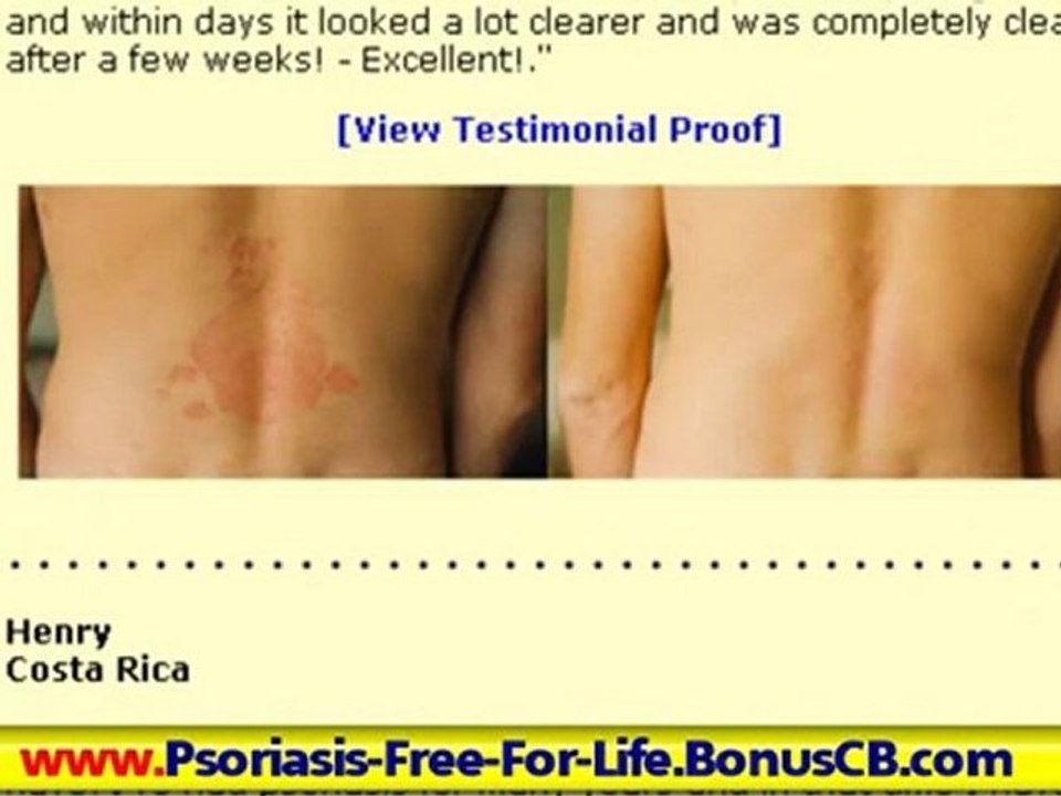 Psoriasis Remedies - Scalp Psoriasis Treatment