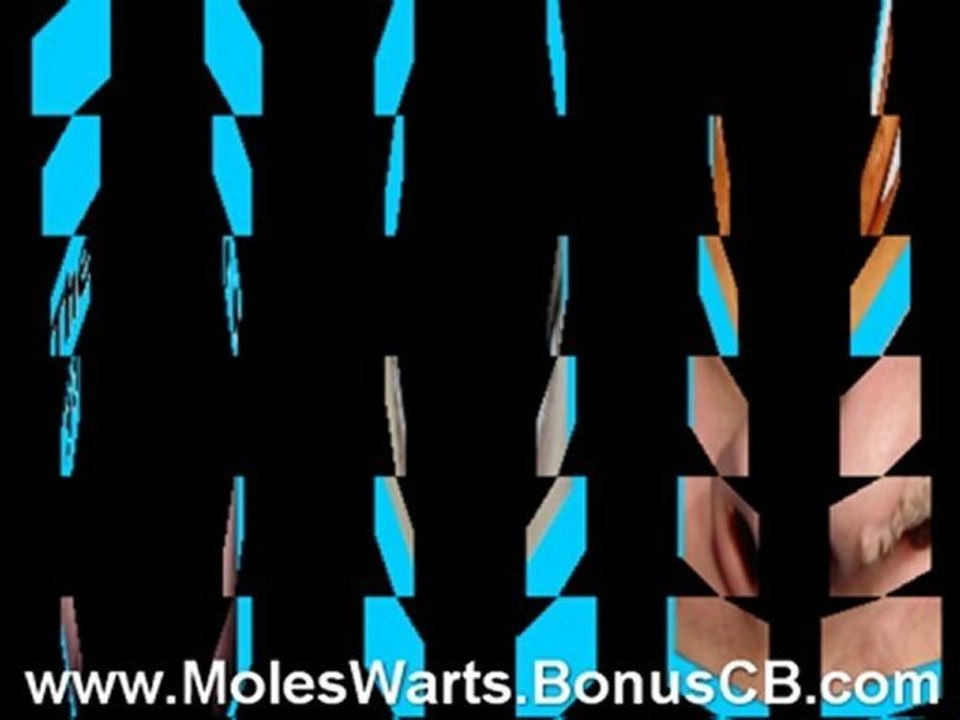 Mole Removal On Nose - Male Genital Warts Removal