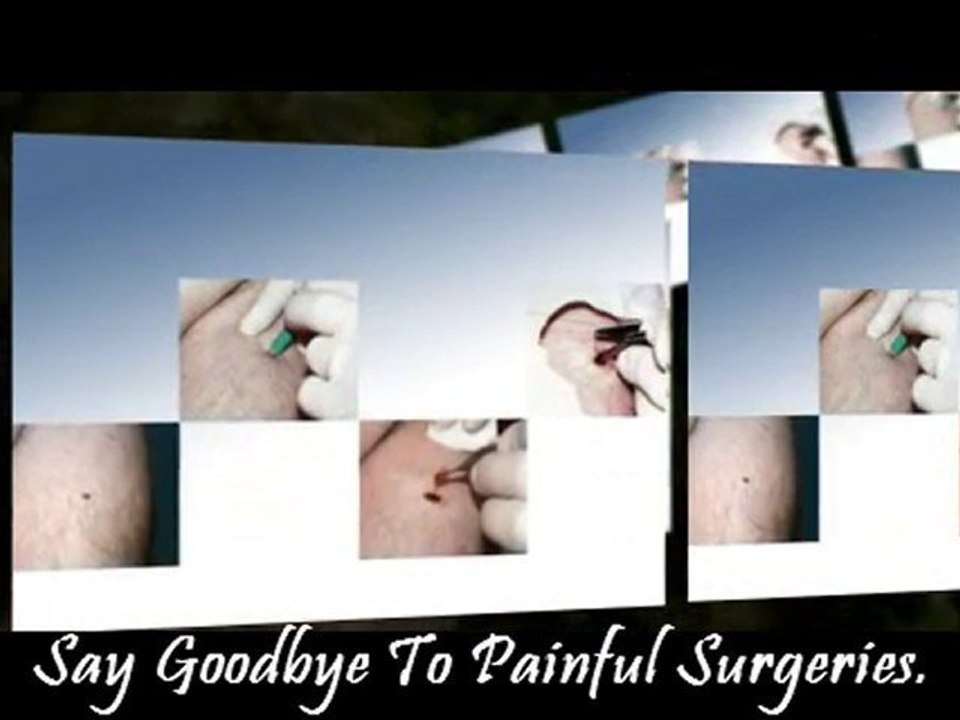 Get The Best Natural Mole Removal Cream