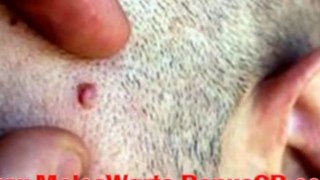 Mole Removal On Neck - Warts Removal On Face