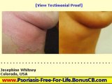 Natural Psoriasis Cure - Psoriasis On Leg