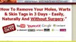 Removing Moles Naturally - How To Remove Warts Fast