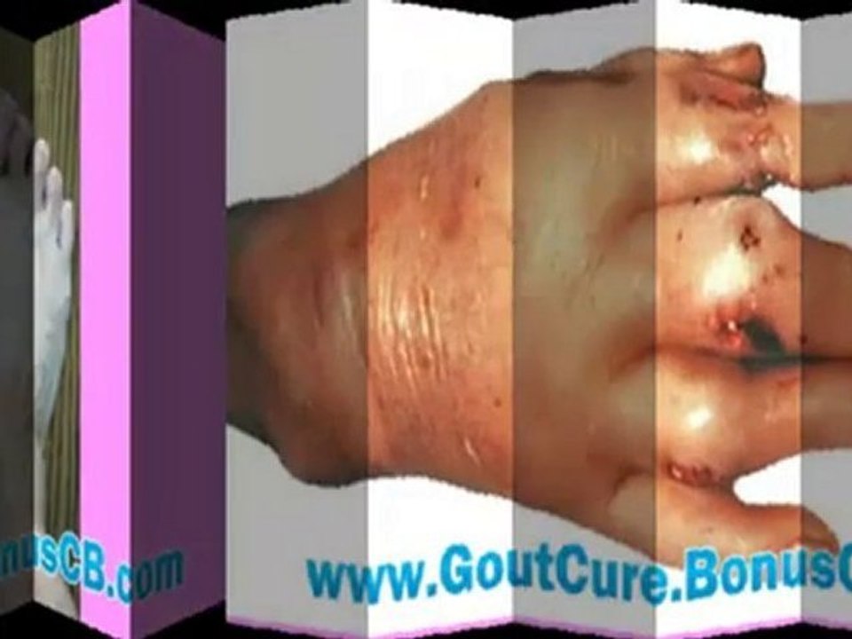 gout cure - gout treatment - gout removal - gout relief