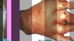 gout pain relief - gout remedy - the gout remedy report
